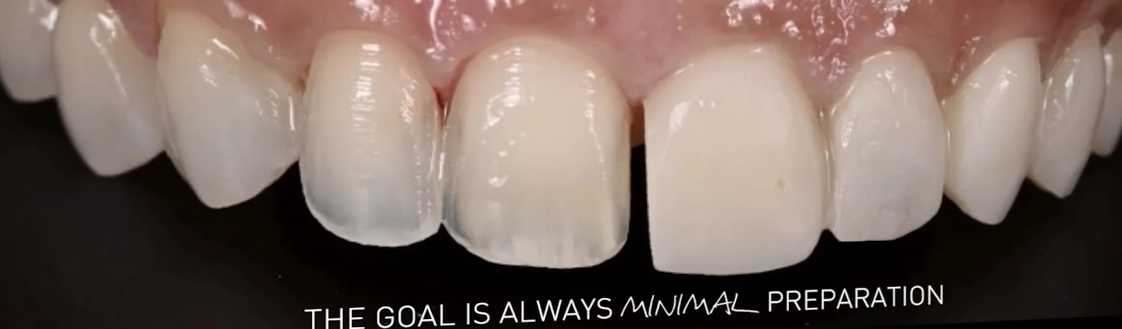 Close-up of upper anterior teeth during a Veneer case, from a Details slide that reads: the goal is always minimal preparation